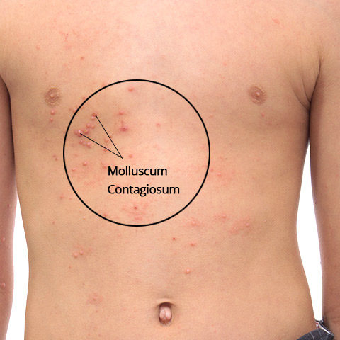 Molluscum-Contagiosum-In-Children-1