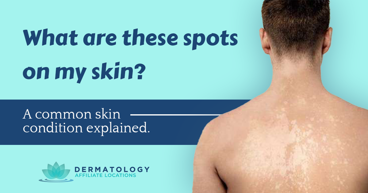 What are these spots on my skin? Tinea Versicolor Explained - SJH Derm