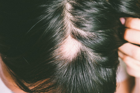 alopecia areata alopecia areata