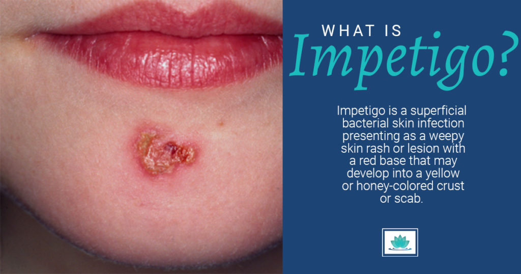 Impetigo What is it and How It Affects You SJH Derm