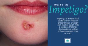Impetigo: What is it and How It Affects You - SJH Derm
