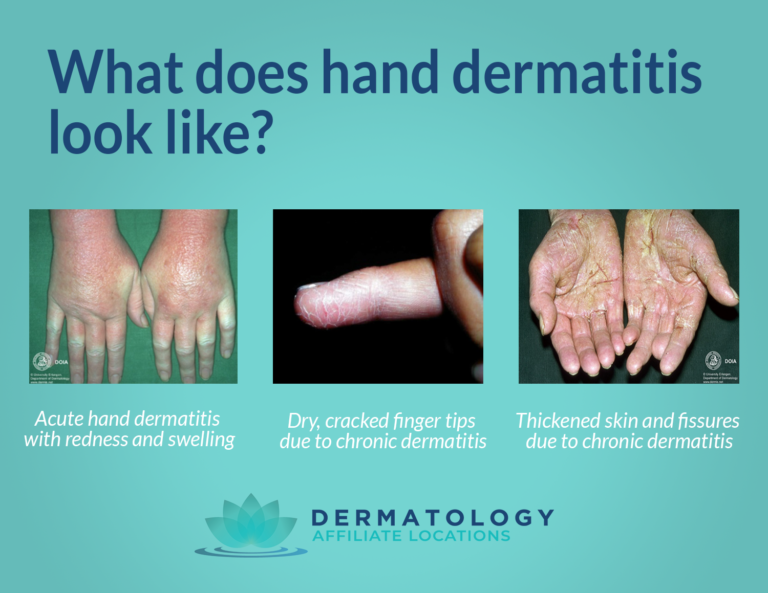 Hand Dermatitis: Everything You Should Know for Prevention & More