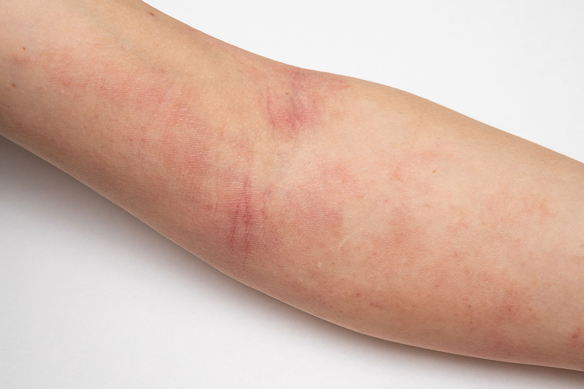 Allergic Contact Dermatitis What To Know Sjh Derm 
