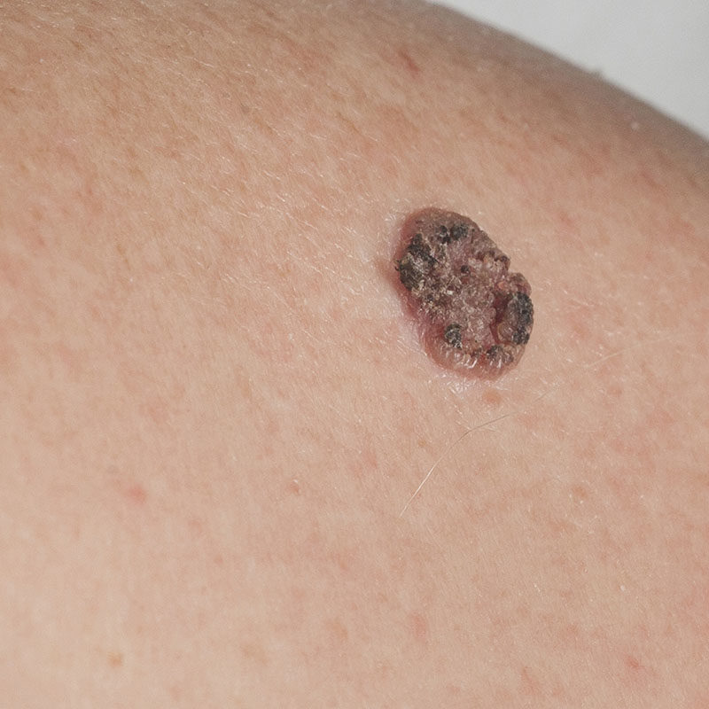 squamous cell carcinoma