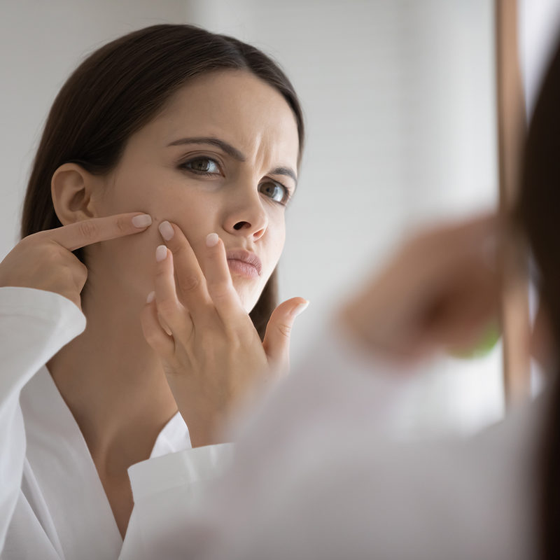 Woman with acne