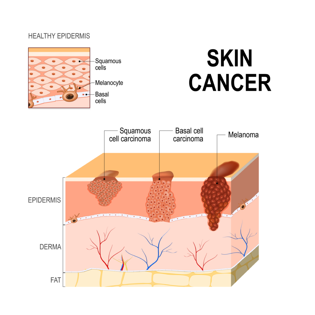 Skin Cancer depicting types of skin cancer and their severity.