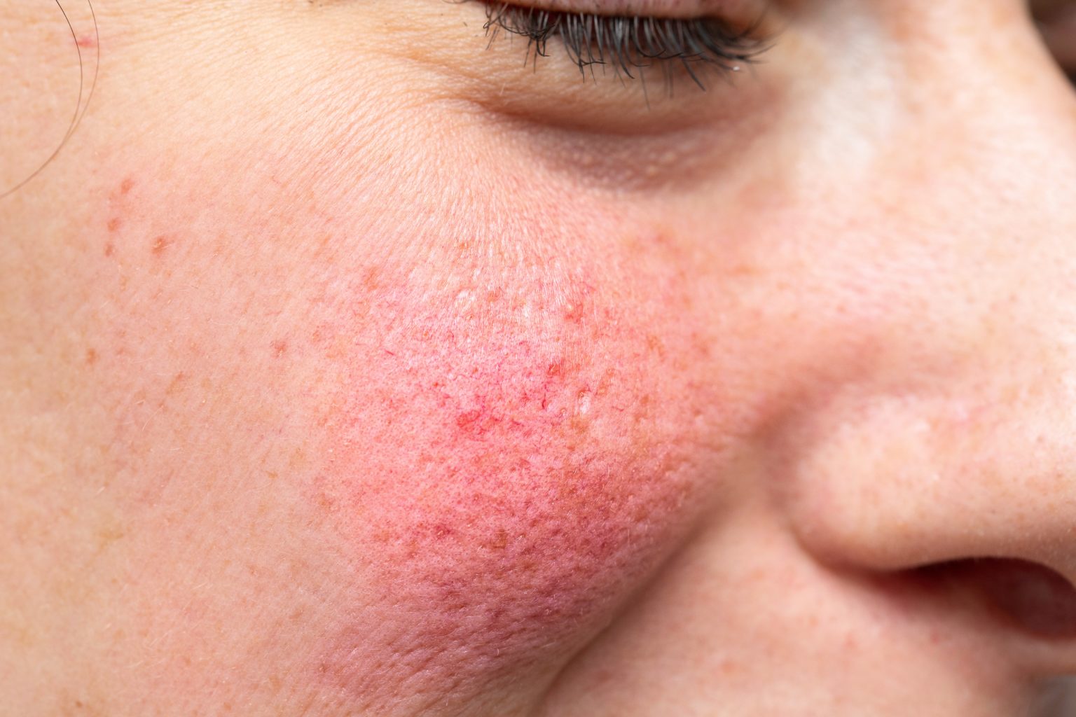 Rosacea - SJH Derm